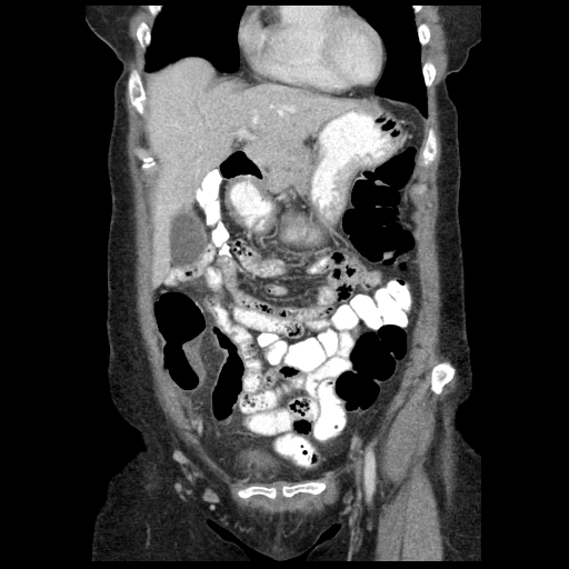 Acute appendicitis (Radiopaedia 52672-58589 Coronal C+ portal venous phase 16).jpg