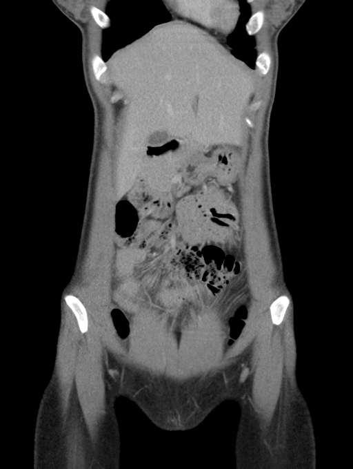 Acute appendicitis (Radiopaedia 62608-70901 Coronal C+ portal venous phase 6).jpg