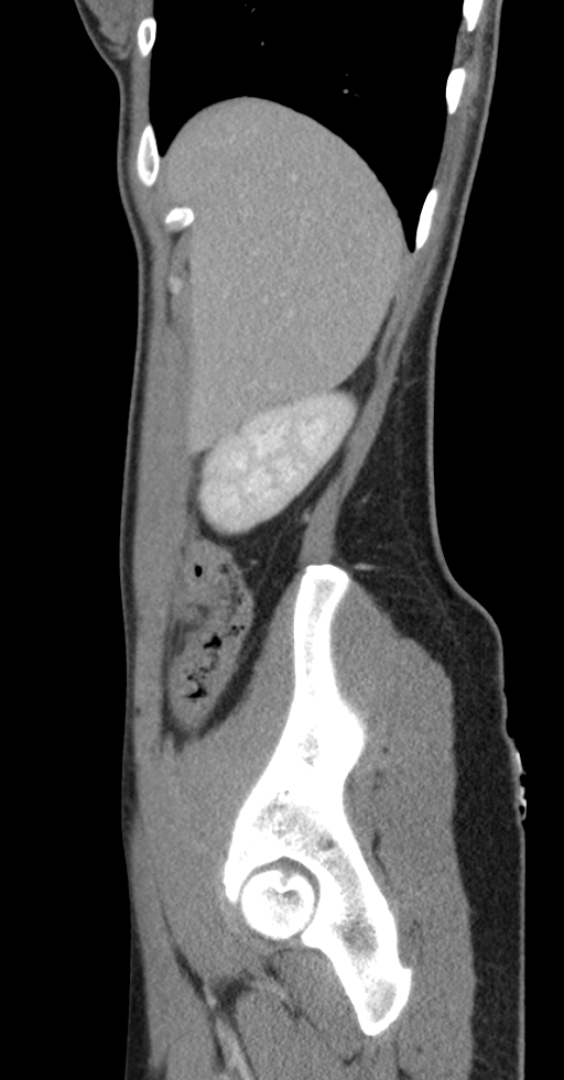 Acute appendicitis (Radiopaedia 62608-70901 Sagittal C+ portal venous phase 51).jpg