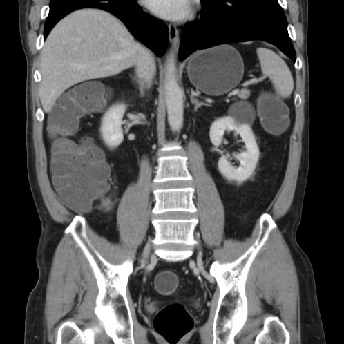 Acute appendicitis (Radiopaedia 66513-75790 Coronal C+ portal venous phase 50).jpg