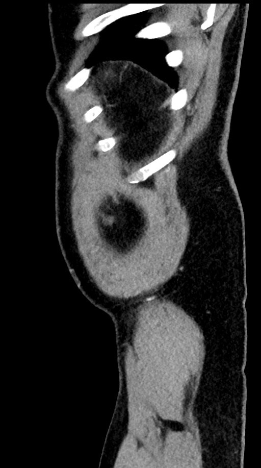 Acute appendicitis (Radiopaedia 77016-88960 Sagittal C+ portal venous phase 10).jpg