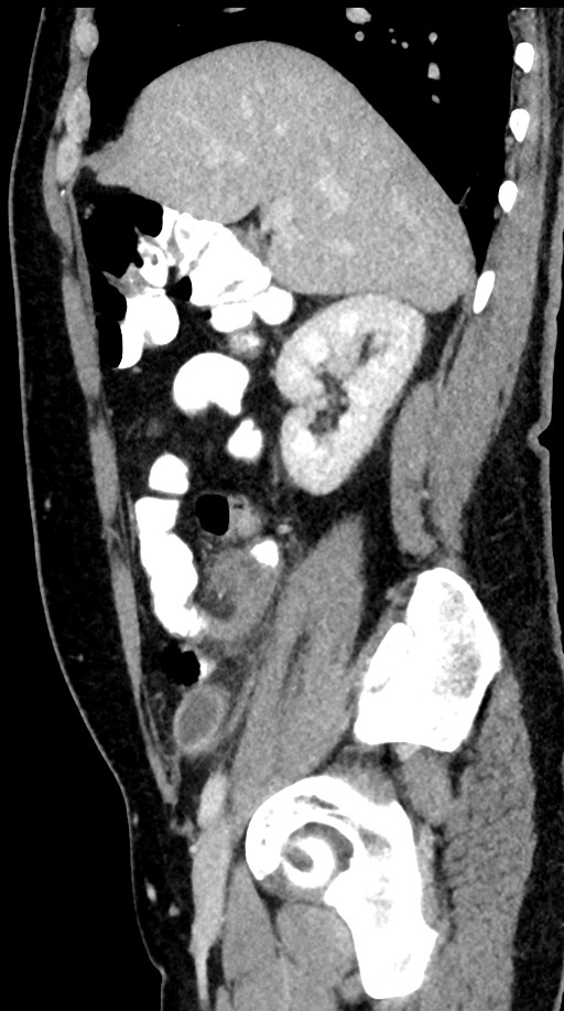 Acute appendicitis (Radiopaedia 77016-88960 Sagittal C+ portal venous phase 79).jpg