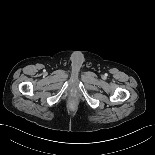 File:Acute appendicitis - large appendicoliths (Radiopaedia 61805-69820 Axial C+ portal venous phase 145).jpg