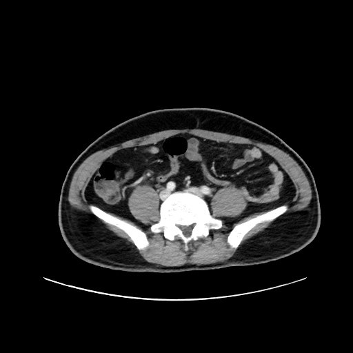 Acute appendicitis and COVID 19 pneumonia (Radiopaedia 76604-88380 Axial C+ portal venous phase 55).jpg