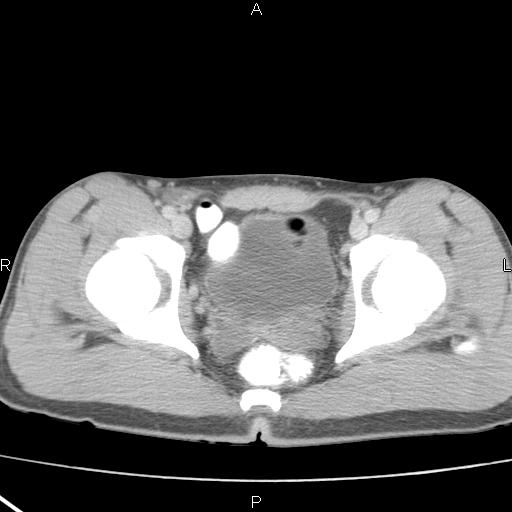 File:Acute appendicitis with CT arrowhead sign (Radiopaedia 21474-21411 Axial C+ portal venous phase 38).jpg
