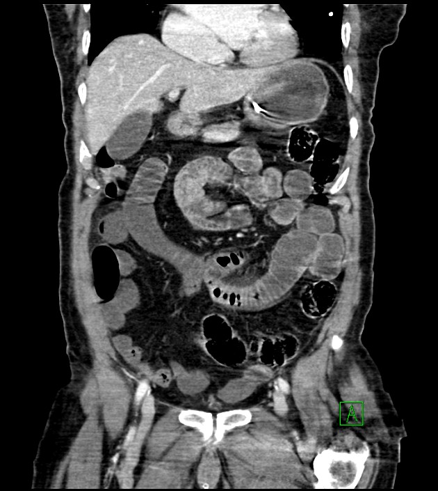 Acute arterial mesenteric ischemia (Radiopaedia 78238-90828 Coronal C+ portal venous phase 39).jpg