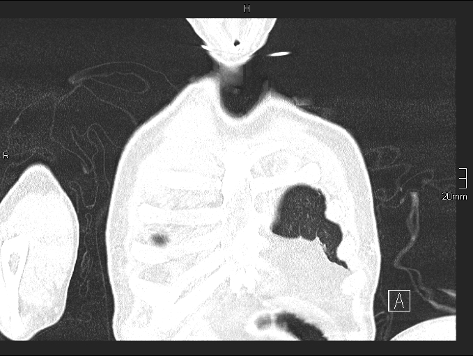 Acute aspiration pneumonitis (Radiopaedia 55642-62166 Coronal lung window 8).jpg