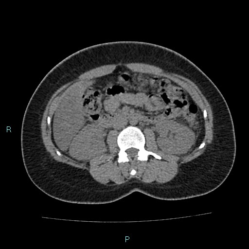 Acute bilateral pyelonephritis (Radiopaedia 37146-38881 Axial non-contrast 48).jpg