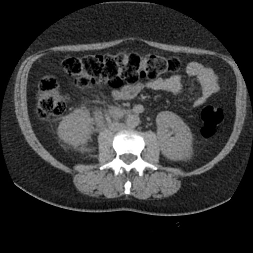 Acute cholecystitis and ureteric colic (Radiopaedia 42330-45444 Axial prone 51).jpg