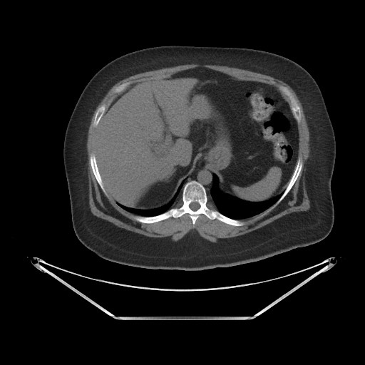 File:Acute cholecystitis with tensile fundus sign (Radiopaedia 71394-81723 Axial non-contrast 7).jpg