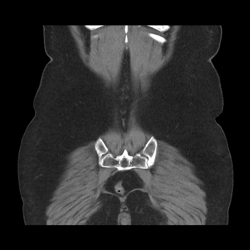 Acute cholecystitis with tensile fundus sign (Radiopaedia 71394-81723 Coronal non-contrast 104).jpg