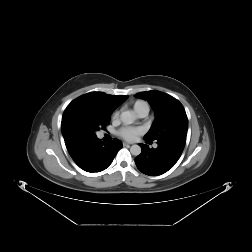 File:Acute complicated calculous cholecystitis (Radiopaedia 55202-61587 Axial C+ delayed 5).jpg