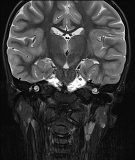 File:Acute disseminating encephalomyelitis with bilateral optic neuritis (Radiopaedia 79676-92886 Coronal STIR 22).jpg