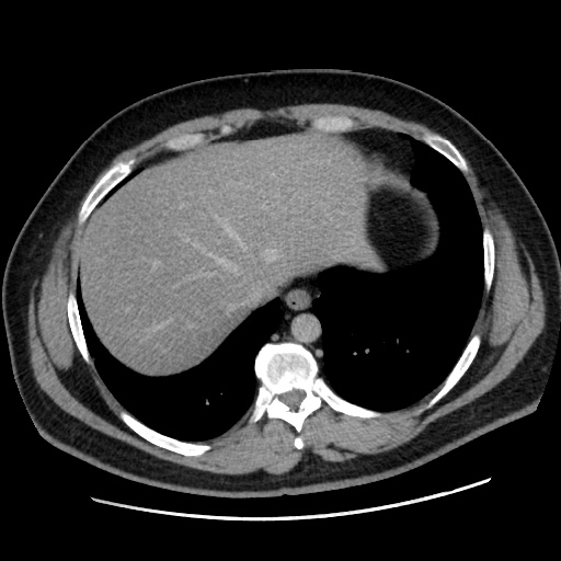 File:Acute diverticulitis with localized perforation (Radiopaedia 41296-44113 Axial C+ portal venous phase 13).jpg
