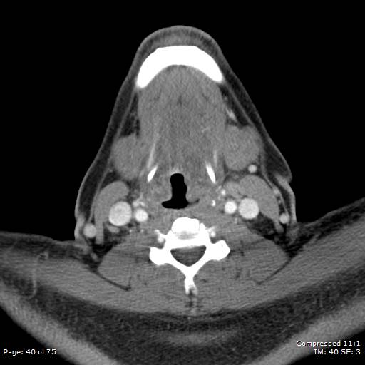 Acute epiglottitis (Radiopaedia 54375-60590 Axial C+ arterial phase 40).jpg