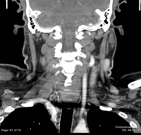 Acute epiglottitis (Radiopaedia 54375-60590 Coronal C+ arterial phase 47).jpg