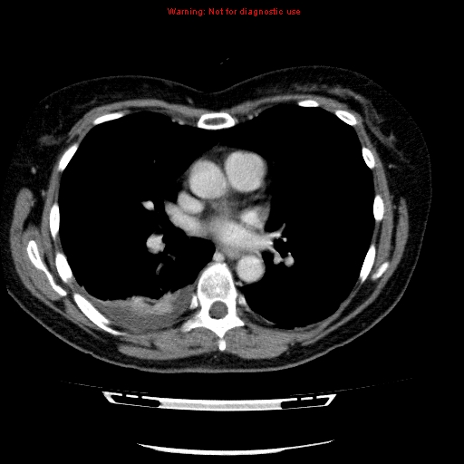 Acute gangrenous cholecystitis (Radiopaedia 10123-10661 Axial C+ portal venous phase 1).jpg
