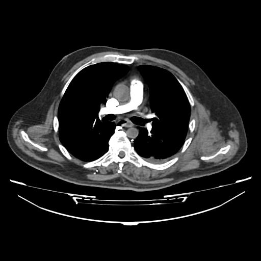 Acute heart failure (CT) (Radiopaedia 79835-93075 Axial C+ arterial phase 9).jpg
