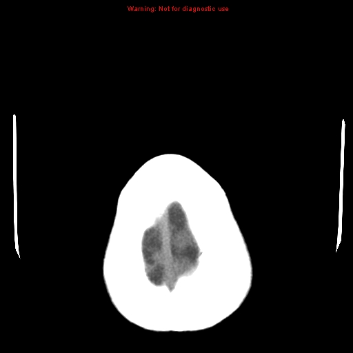 File:Acute infarction (Radiopaedia 12332-12615 Axial non-contrast 33).jpg