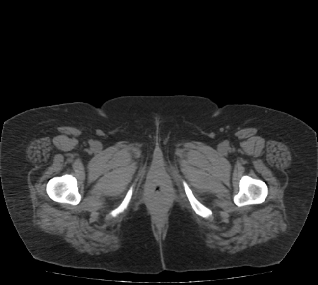 Acute mesenteric ischemia (Radiopaedia 80029-93316 Axial non-contrast 94).jpg