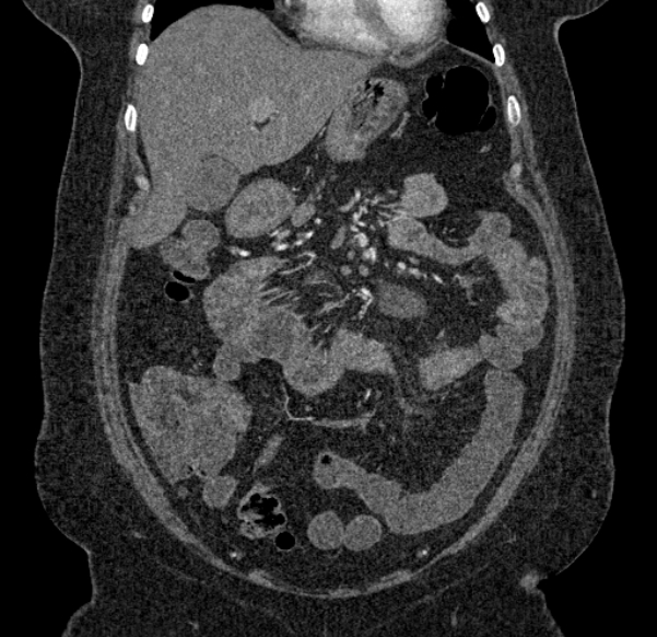 Acute mesenteric ischemia (Radiopaedia 80029-93316 Coronal C+ arterial phase 41).jpg