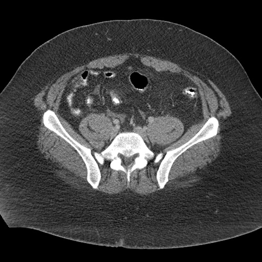 File:Acute mesenteric venous ischemia (Radiopaedia 46041-50383 Axial C+ portal venous phase 100).jpg