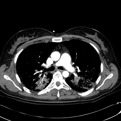 Acute myocardial infarction in CT (Radiopaedia 39947-42415 Axial C+ arterial phase 53).jpg