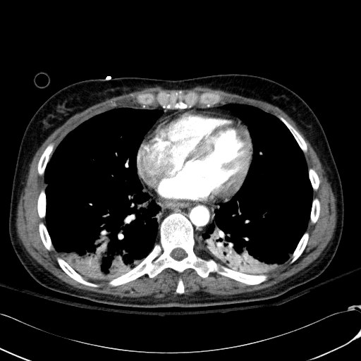 File:Acute myocardial infarction in CT (Radiopaedia 39947-42415 Axial C+ arterial phase 91).jpg