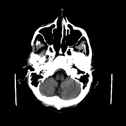 File:Acute necrotizing toxoplasma encephalitis (Radiopaedia 10683-11150 B 27).jpg