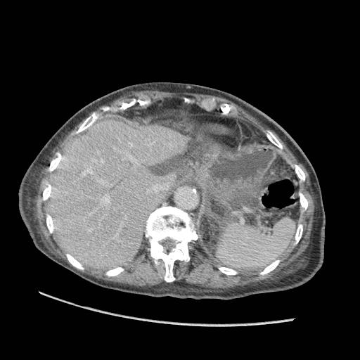 Acute on chronic pancreatitis (Radiopaedia 13233-13244 Axial C+ portal venous phase 14).jpg