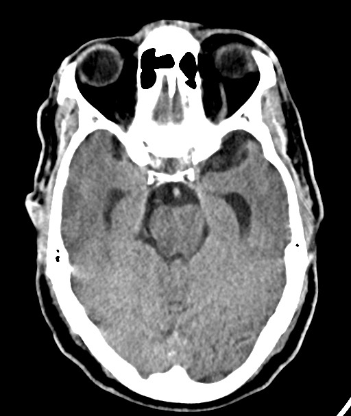 Acute on chronic subdural hematoma (Radiopaedia 78346-90966 Axial non-contrast 25).jpg