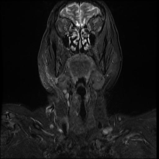 File:Acute otitis externa (Radiopaedia 57296-64236 Coronal STIR 5).jpg