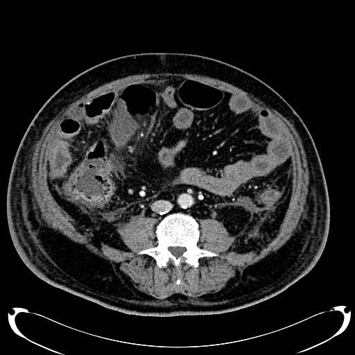Acute pancreatic necrosis (Radiopaedia 13560-18500 Axial C+ portal venous phase 95).jpg