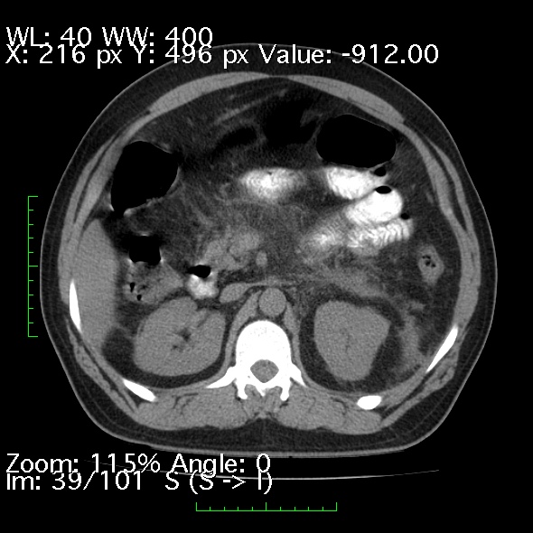 Acute pancreatitis (Radiopaedia 34043-35276 Axial non-contrast 39).jpg