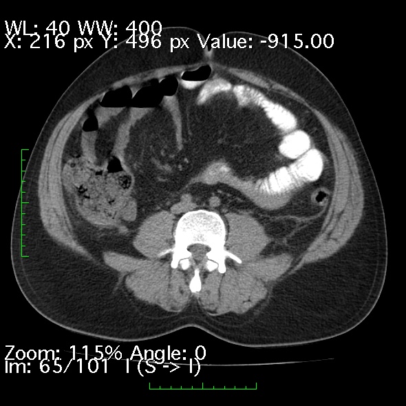 Acute pancreatitis (Radiopaedia 34043-35276 Axial non-contrast 65).jpg