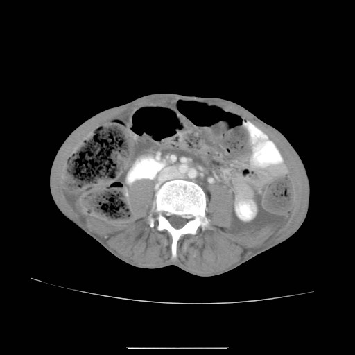 File:Acute pancreatitis (Radiopaedia 50213-55558 Axial C+ portal venous phase 31).jpg