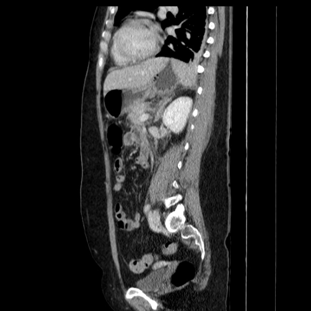 Acute pancreatitis - Balthazar C (Radiopaedia 26569-26714 Sagittal C+ portal venous phase 42).jpg