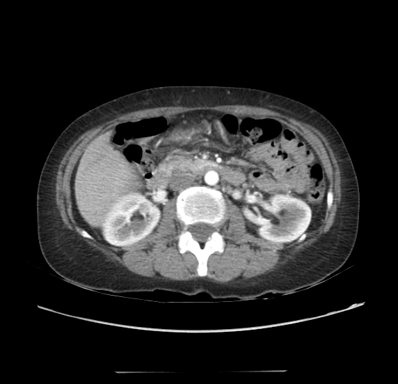 File:Acute pancreatitis - Balthazar E - post ERCP (Radiopaedia 27562-27772 Axial C+ arterial phase 25).png