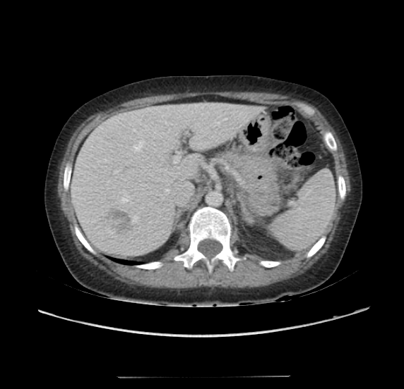 File:Acute pancreatitis - Balthazar E - post ERCP (Radiopaedia 27562-27772 Axial C+ portal venous phase 21).png