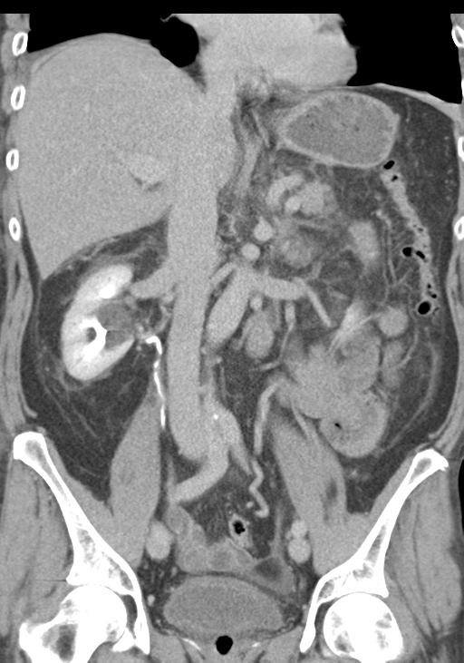 Acute pancreatitis and walled-off necrosis (Radiopaedia 29888-30403 E 31).jpg