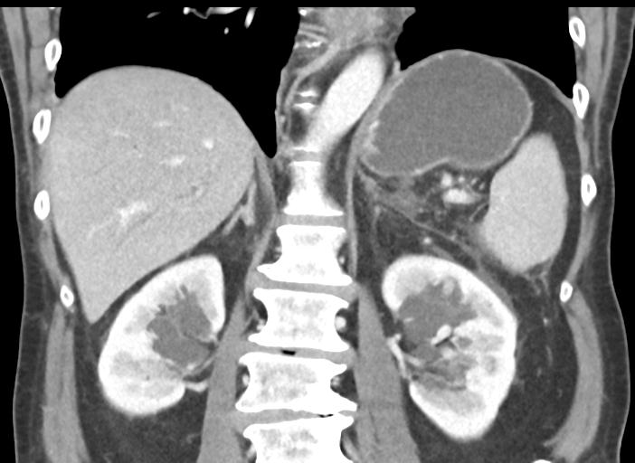 File:Acute pancreatitis and walled-off necrosis (Radiopaedia 29888-30404 Coronal C+ portal venous phase 35).jpg