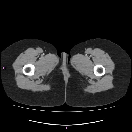 Acute pancreatitis secondary to stone at minor papilla and pancreatic divisum (Radiopaedia 76570-88333 Axial C+ portal venous phase 92).jpg