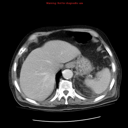 File:Acute pancreatitis with incidental pancreatic lipoma (Radiopaedia 10190-10730 Axial C+ portal venous phase 12).jpg