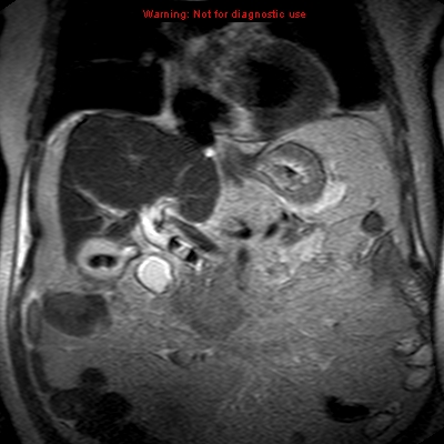 File:Acute pancreatitis with incidental pancreatic lipoma (Radiopaedia 10190-10732 Coronal T2 14).jpg