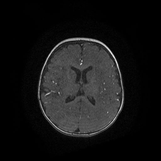 Acute phase of hemiconvulsion-hemiplegia epilepsy syndrome (Radiopaedia 29309-29745 Axial TOF angiography 34).jpg