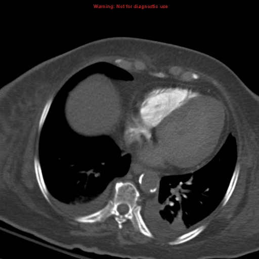 Acute pulmonary embolism (Radiopaedia 13286-13289 Axial C+ CTPA 47).jpg
