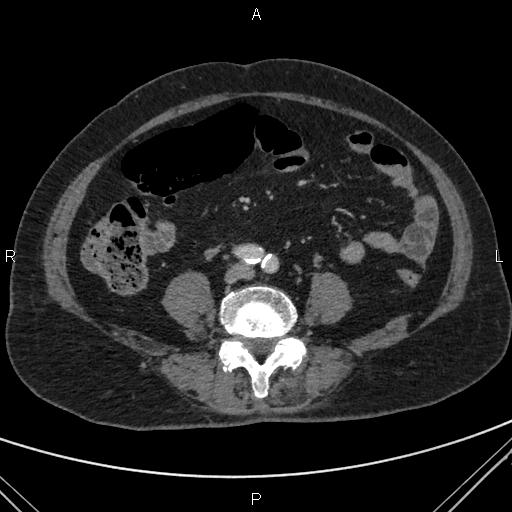 File:Acute renal artery occlusion (Radiopaedia 86586-102682 Axial C+ portal venous phase 59).jpg
