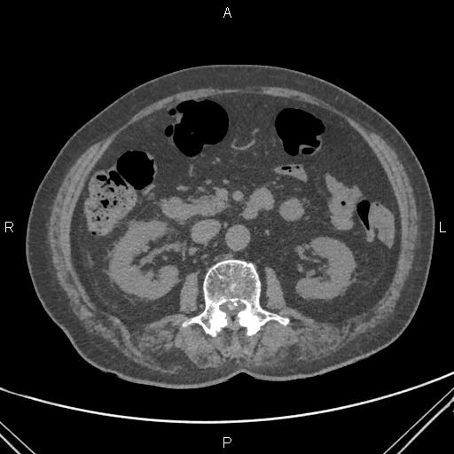 File:Acute renal artery occlusion (Radiopaedia 86586-102682 Axial non-contrast 33).jpg