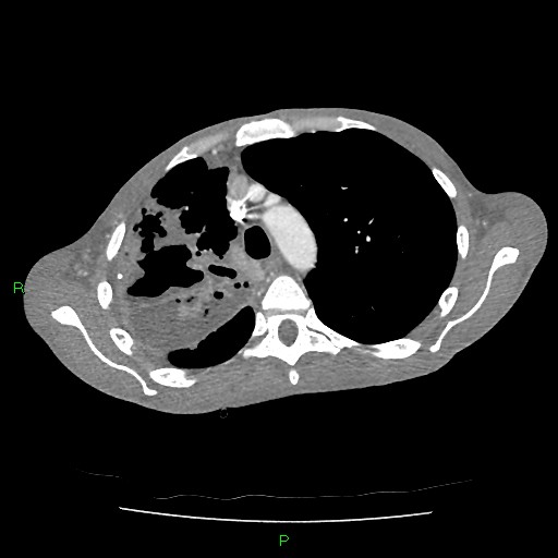 File:Acute right lung abscess (Radiopaedia 34806-36258 Axial C+ arterial phase 52).jpg