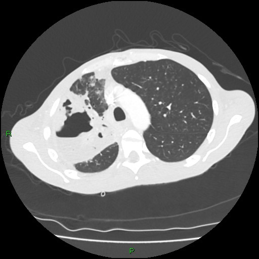 Acute right lung abscess (Radiopaedia 34806-36258 Axial lung window 55).jpg